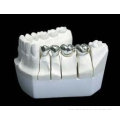 Full Cast Gold Restoration Of Metal Dental Crown With Non Precious, Semiprecious Teeth